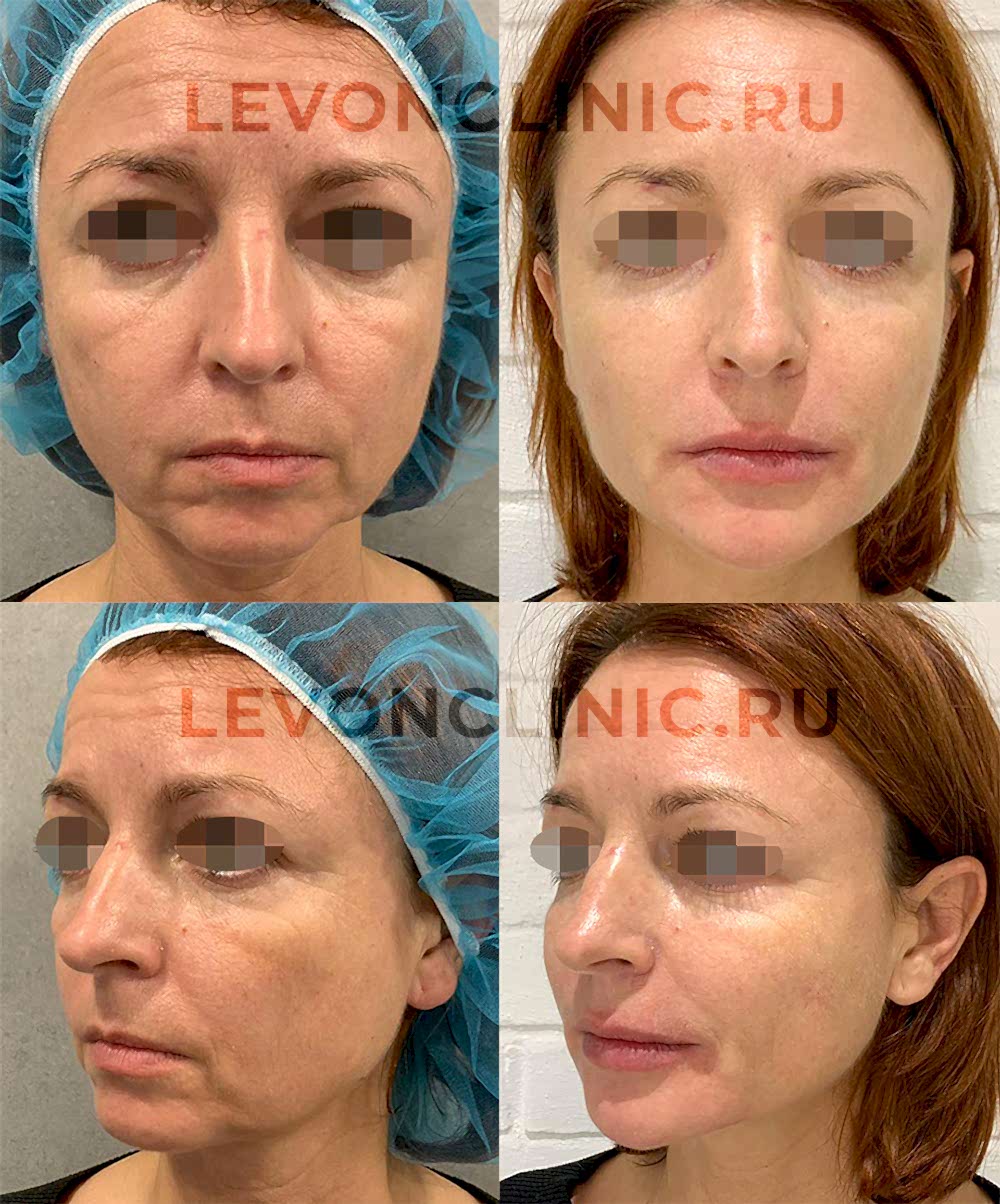 Пример коррекции и омоложения овала лица
