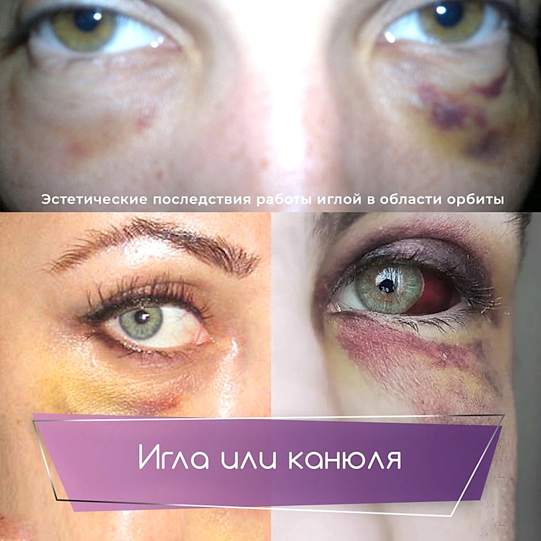 последствия работы иглой, фото из интернета